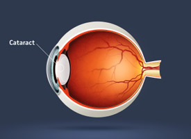 cataract treatment